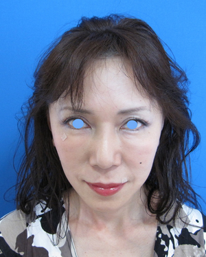 目の下のたるみ、目のくまでお悩みの方、切らずに完璧に解決します。TCB-R法　手術直後　症例写真